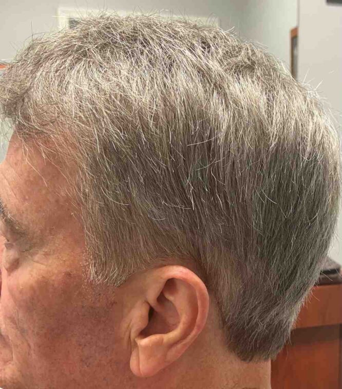 Non-Surgical Hair Replacement Male